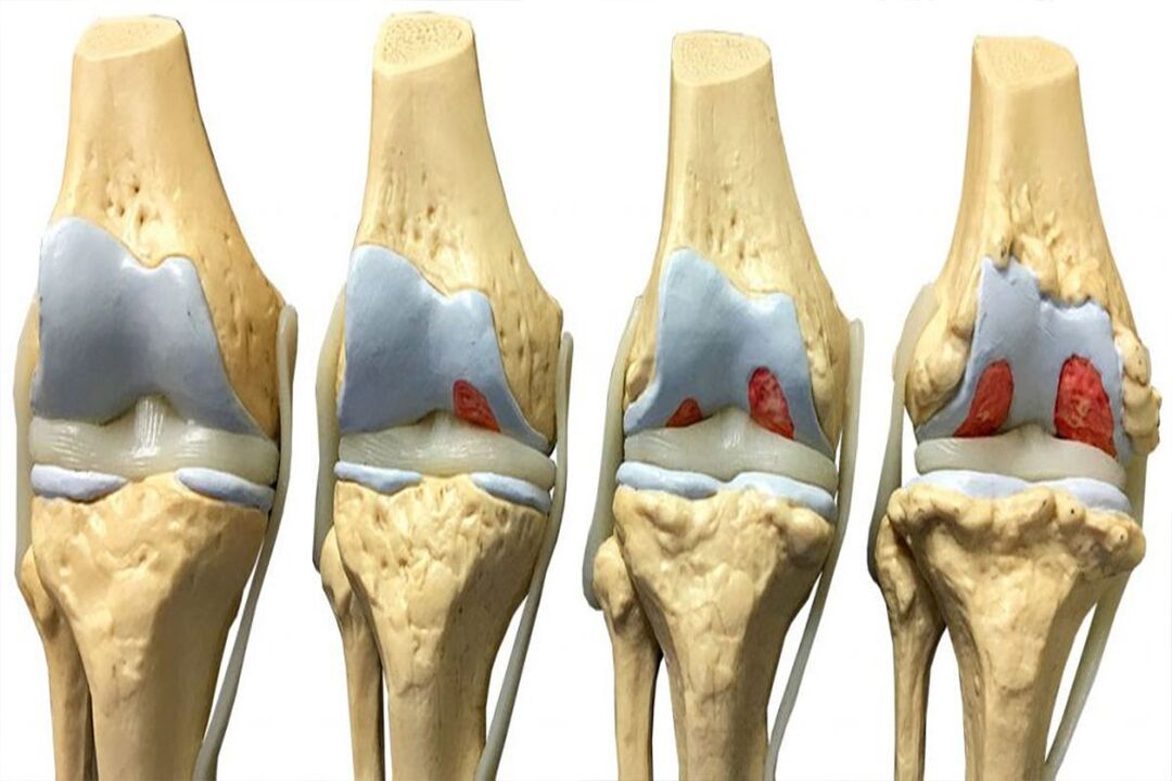 Peringkat perkembangan osteoarthritis