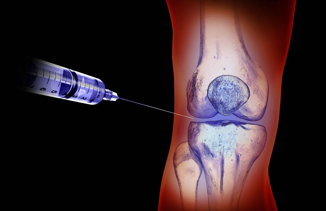 suntikan intra-artikular untuk osteoarthritis