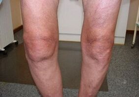 Cara merawat arthrosis sendi lutut