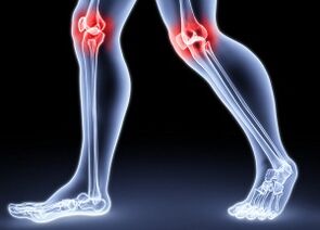 Sebab -sebab pembangunan osteoarthritis lutut