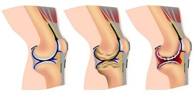 Tahap pembangunan arthrosis sendi lutut