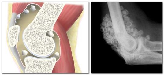 Chondromatosis dengan kesakitan pada sendi pinggul