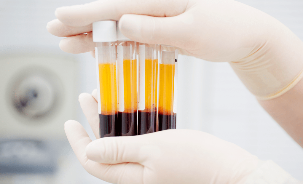 Plasma kaya platelet untuk terapi PRP untuk osteoarthritis