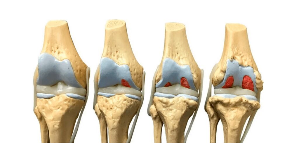 Tahap arthrosis sendi